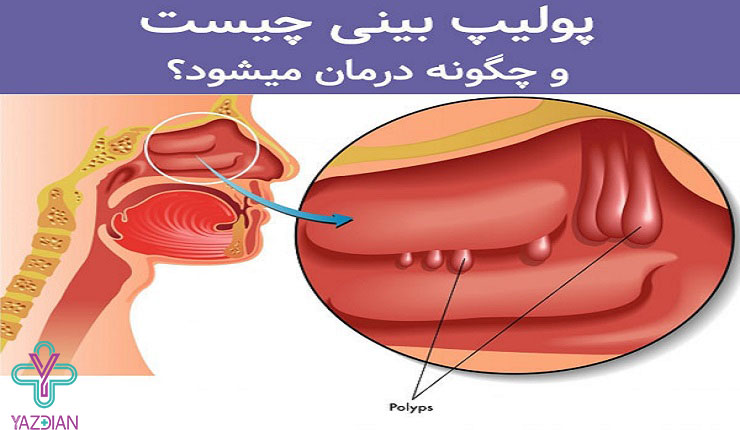 پولیپ حنجره